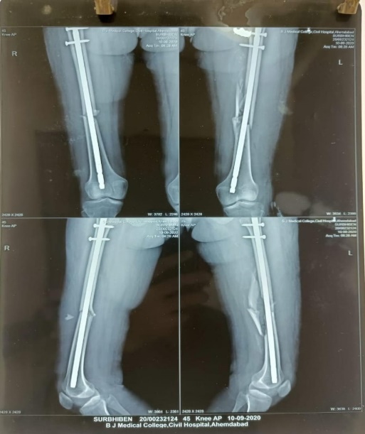 Primary post-operative bilateral shaft femur with interlocking nail in situ