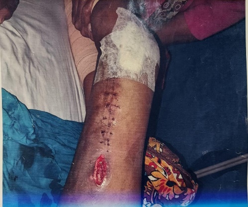 Local site of proximal suture line with active discharge
