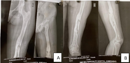 Left non- united shaft femur with osteomyelitic changes
