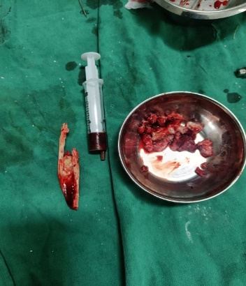 Intra- operative sequestrum and bone graft.