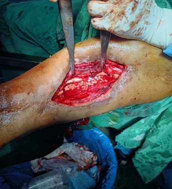 Intra- operative stimulan (antibiotic beads) insertion.