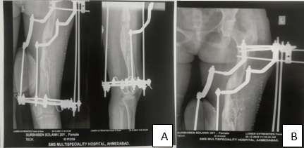 Immediate post-operative radiograph after ilizarov fixation.