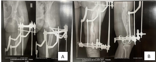 Post-operative x-ray after 1 month follow up