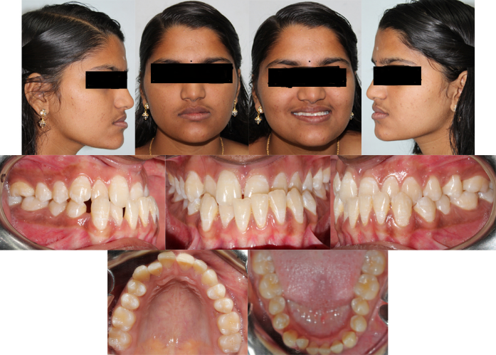 Pre treatment facial and intra oral photographs