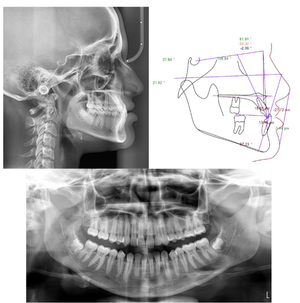 Pre treatment lateral cephalometric and panoramic radiographs