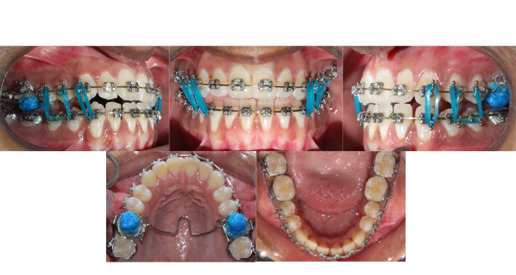 Intra oral clinical photographs showing segmentation of maxillary arch wire with vertical intermaxillary elastics