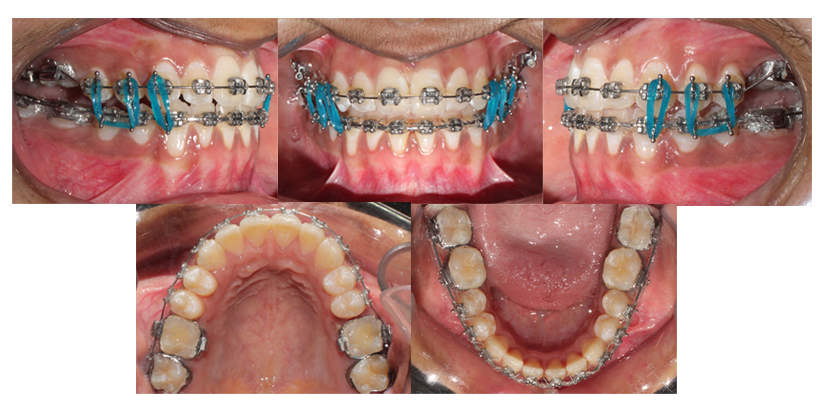 Intra oral clinical photographs showing continuous maxillary arch wire with vertical intermaxillary elastics
