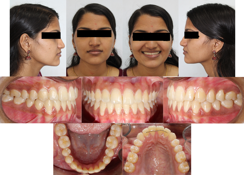 Post treatment facial and intra oral photographs