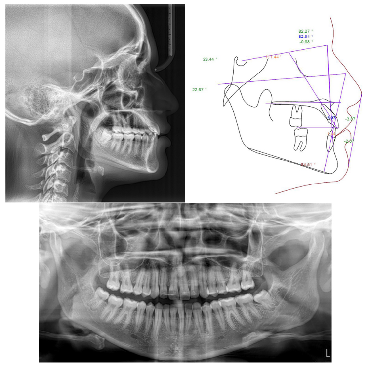 Post treatment lateral cephalometric and panoramic radiographs