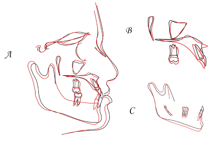 Pre treatment (Black line) and Post treatment(Red line) cephalometric tracings, with superimposition on A, Cranial base; B, Anterior wall of zygomatic process; C, Mandibular canal