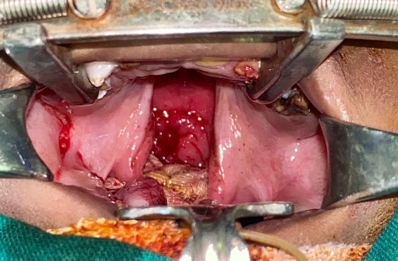 Secondary cleft palate defect.