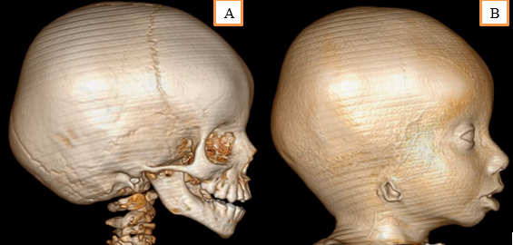 A: 3D facial bone showing the hypo plastic mandible on the right side with well-formed condyle and coronoid processes, B: 3D soft tissue CT of face showing the frontal bossing, right aural atresia with EAC, hypo plastic mandible and retrogenium.