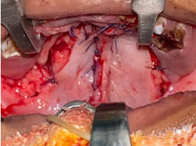 Bardach’s two flap palatoplasty- intraoperative photograph