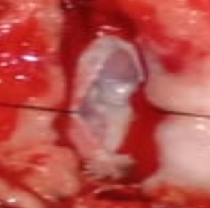Intraoperative pearl like intradural tumour