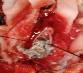 Cheese like material oozing out during decompression of cyst.