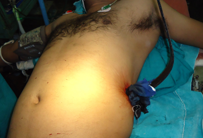 The preoperative position on the table with the iron bar seen penetrating the left flank