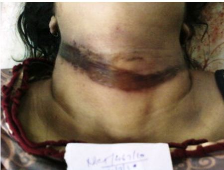Abrasions with hemorrhage