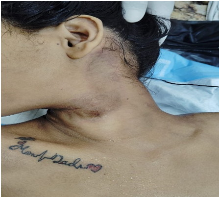 Abrasions with hemorrhage