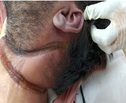 Blister in neck region