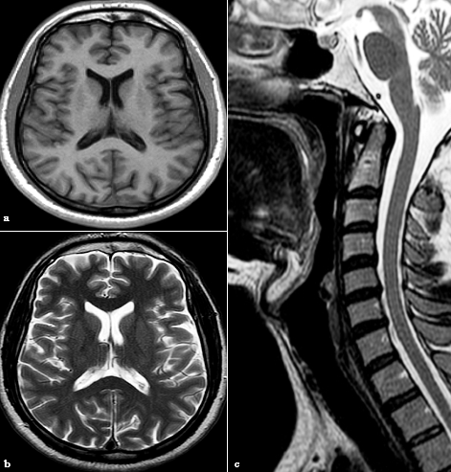 MRI Brain T1 axial section (a), T2 axial section (b) and MRI Cervical spine T2 sagittal section (c) were normal.