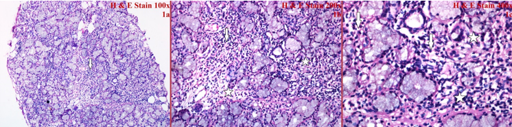 H&E stained sections of labial biopsy show denselymphomononuclear inflammatory infiltrate in the stroma (arrow) with involvement of ducts by the chronic inflammatory cells (star) (1a; 100x, 1b; 200x, 1c; 400x). 