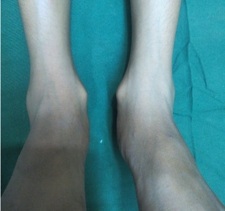 Showing bilateral feet with medial malleolus swelling