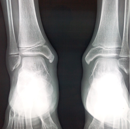 Radiograph showing bilateral fragmented accessory ossification center of medial malleolus