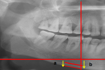 anoramic mandibular index