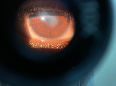 Showing Slit Lamp image of the right eye showing focal stromal oedema in the paraxial area, about 5mm ×3mm mm on the 1st day after exposure