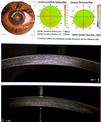Anterior segment OCT on 3rd day showing only posterior corneal oedema and central corneal thickness of 564µm.