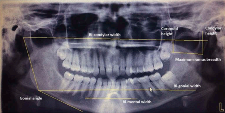 The morphometric parameters taken on OPG to train the AI