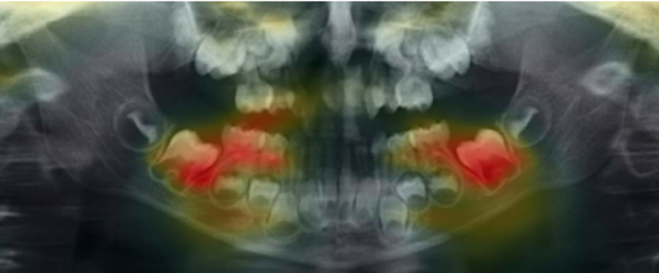 OPG of patients aged 4 years and 8 months old