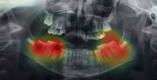 OPG of patients aged 9 years and 8 months old