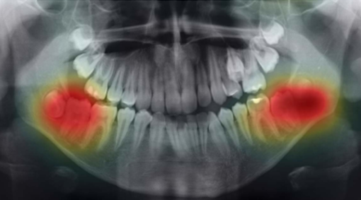 OPG of patients aged 13 years and 2 months old