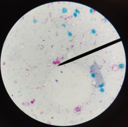 SLIT-SKIN SMEAR- AFB