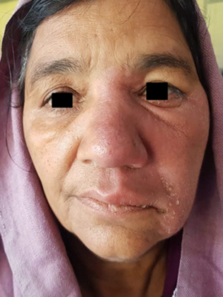 BT Lesion over face with Type-I reaction causing Partial facial nerve palsy