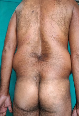 Innumerable BL Leprosy Lesions over back in 60 year old male patient