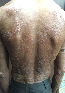 Diffuse Nodular LL