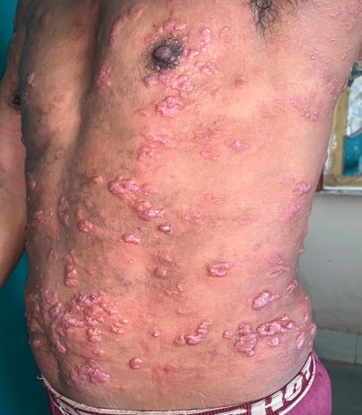 Infiltrative tumid Nodules & Plaques in a case of LL