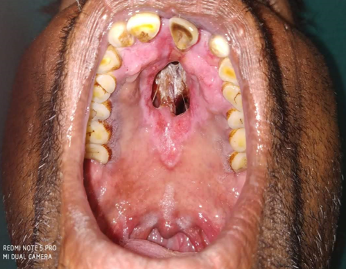 Palatal Lesion and Perforation in a LL patient
