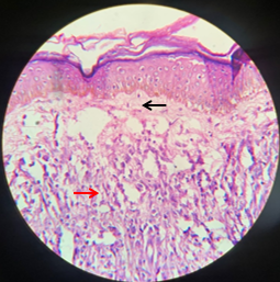 LEPROMATOUS LEPROSY (LL): Atrophic Epidermis, Grenz zone (black arrow) and cellular infiltration predominantly foamy macrophages (red arrow).