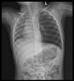 XRay chest PA view showing hyperinflated left lung with mediastinal shift to the right side. Hyperinflated left lung due to foreign body aspiration in left main bronchus