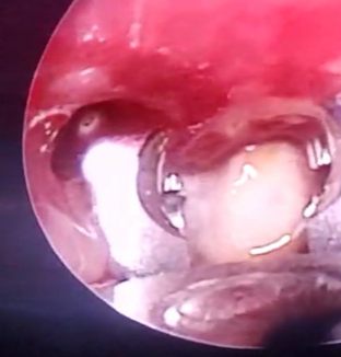 Rigid Bronchoscopy: Peanut piece seen in right main bronchus and removed with optical peanut forceps. 