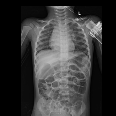 3: X Ray Chest PA view shows midline mediastinum. No air trapping noticed with normal pulmonary vasculatures.