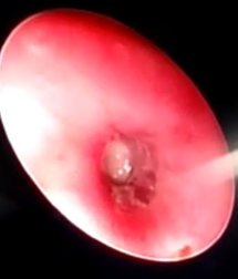 Rigid Bronchoscopy: A smallpeanut piece seen in middle segment of right bronchus