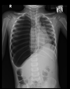 Chest X Ray PA view: Low placed ET just above the carina. RT noted.