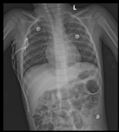 Right intercostal drain tube noted with no significant residual pneumothorax.