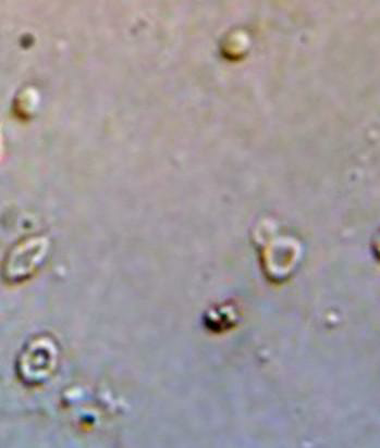 Dysmorphic RBCs on phase contrast microscopy