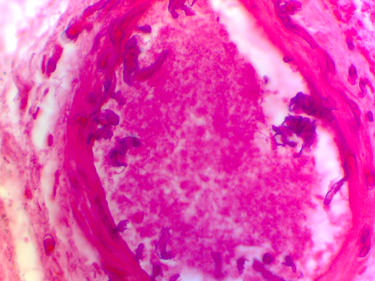 Photomicrograph shows broad, aseptate hyphae of mucormycosis showing angioinvasion, H&E stain 400X
