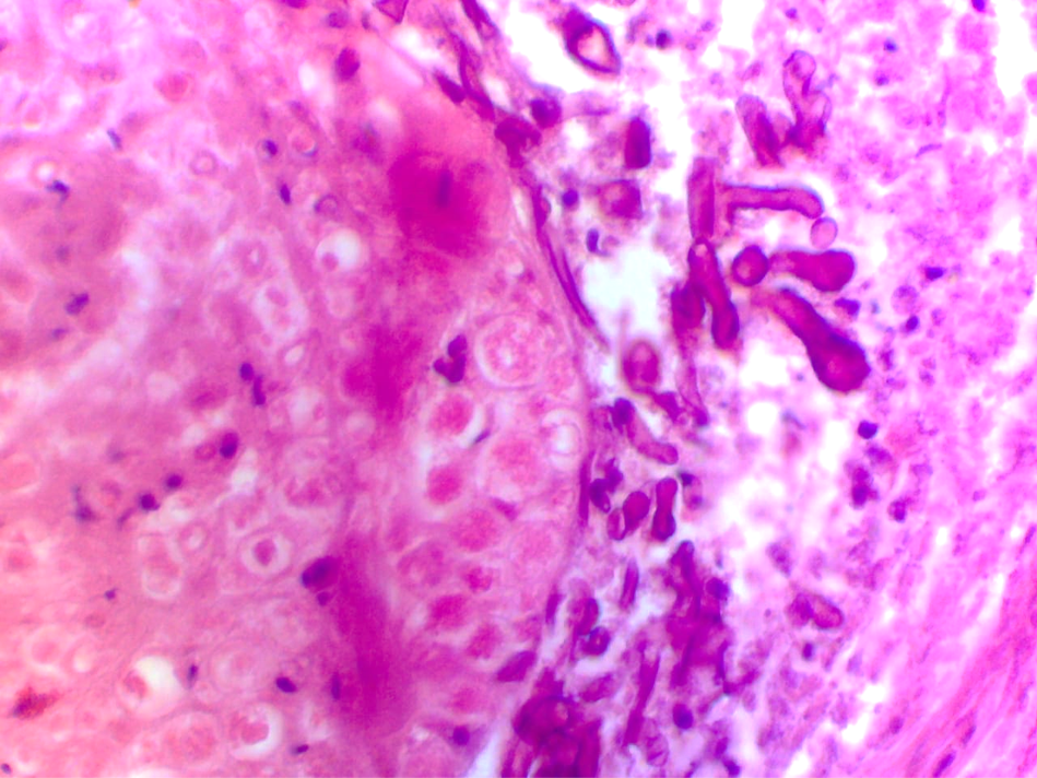 Photomicrograph shows fungal hyphae exhibiting neural invasion, H&E stain 400X